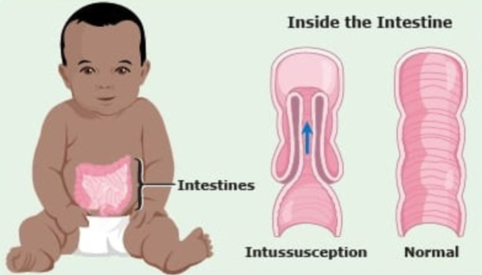 Intussusception in the Child | Pediatric Surgeon | Dr. Geeta Kekre