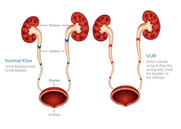 Vesicoureteral Reflux Surgery In Pune | Pediatrician | Dr. Geeta