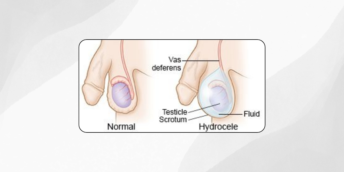 Pediatric and an Adult Hydrocele