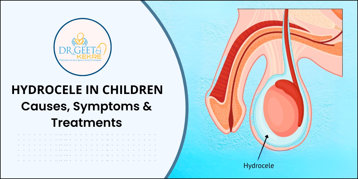 Hydrocele in Children